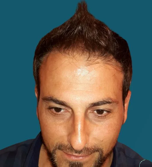 قبل زراعة الشعر، من الأمام