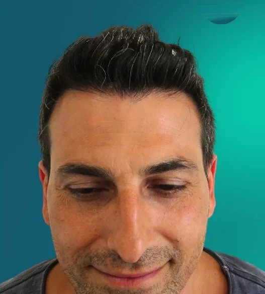 بعد زراعة الشعر، من الأمام