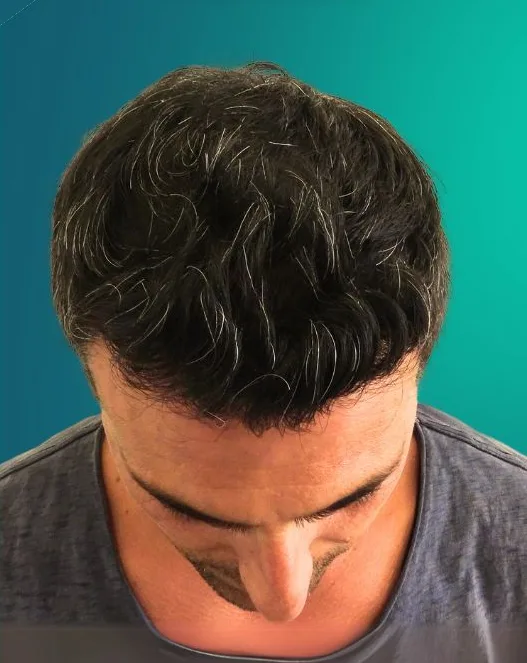 بعد زراعة الشعر، من الأعلى