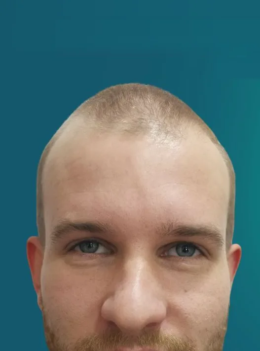 قبل زراعة الشعر، من الأمام