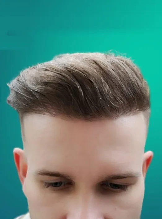 بعد زراعة الشعر، من الأمام