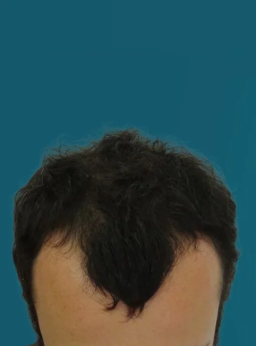 قبل زراعة الشعر، من الأمام