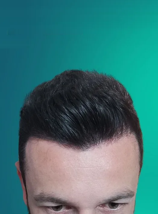 بعد زراعة الشعر، من الأمام