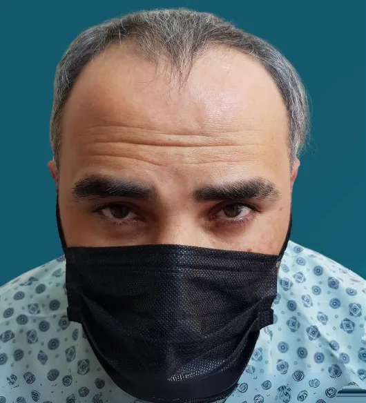 قبل زراعة الشعر، من الأمام