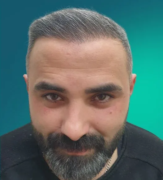 بعد زراعة الشعر، من الأمام