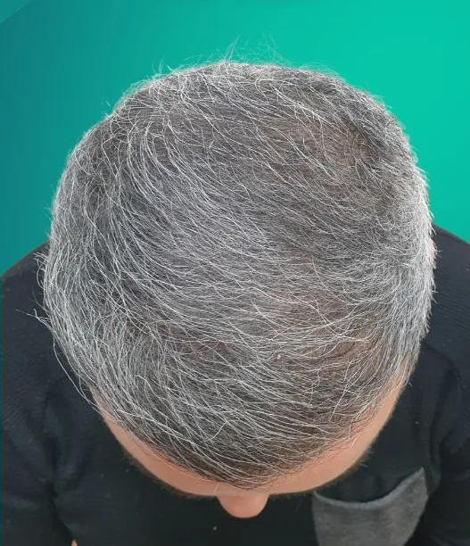 بعد زراعة الشعر، من الأعلى