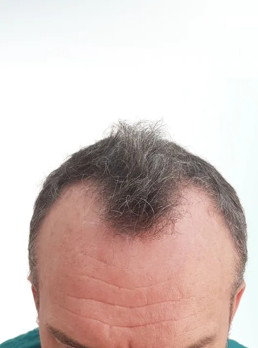 قبل زراعة الشعر، من الأمام