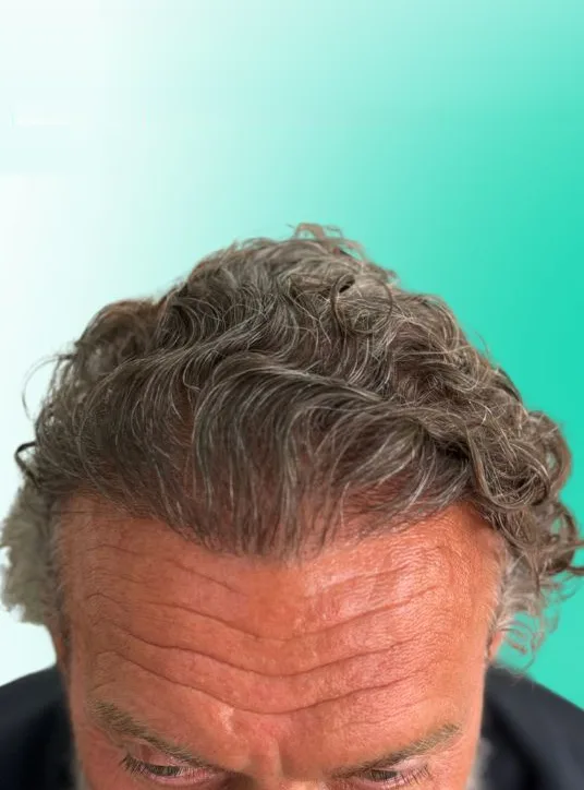 بعد زراعة الشعر، من الأمام