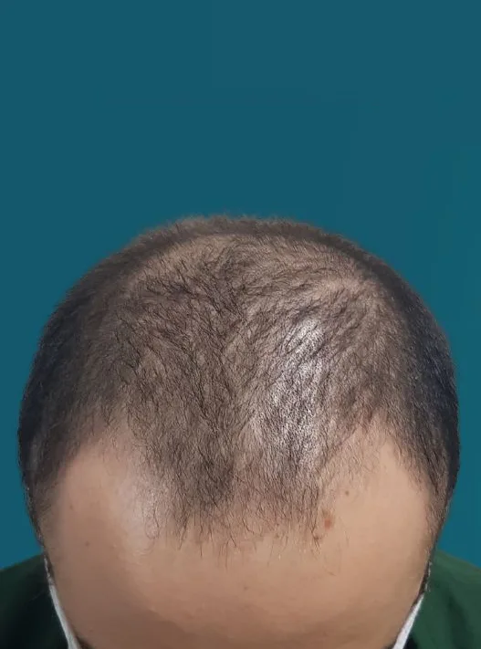 قبل زراعة الشعر، من الأمام