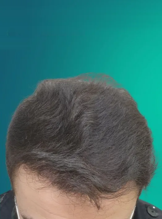 بعد زراعة الشعر، من الأمام