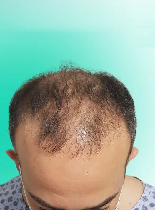قبل زراعة الشعر، من الأمام