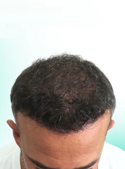بعد زراعة الشعر، من الأمام