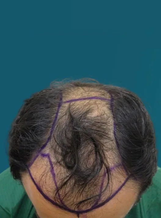قبل زراعة الشعر، من الأمام