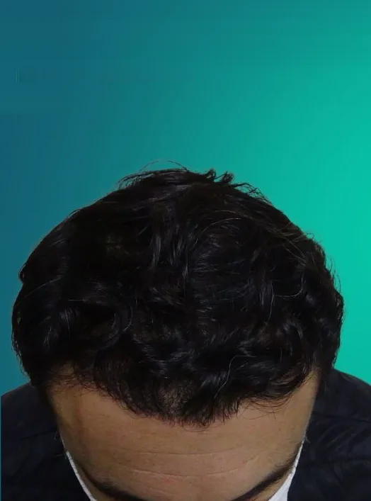 بعد زراعة الشعر، من الأمام