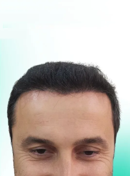 بعد زراعة الشعر، من الأمام
