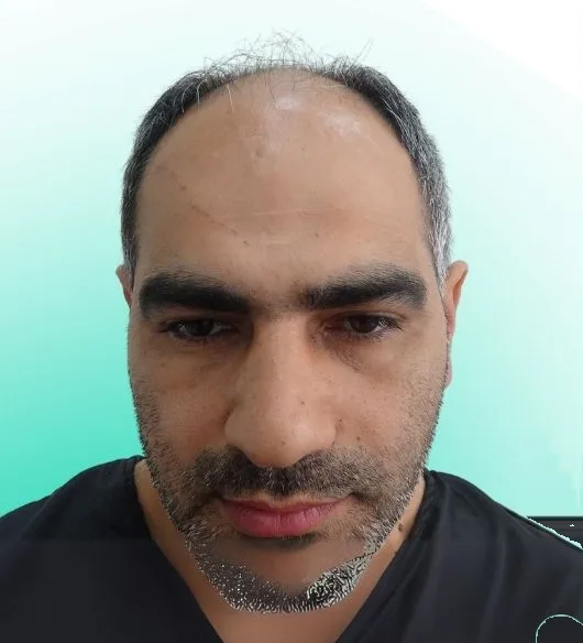 قبل زراعة الشعر، من الأمام