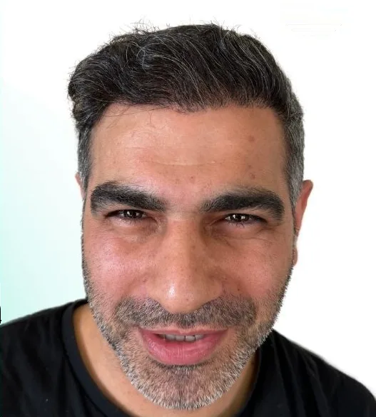 بعد زراعة الشعر، من الأمام