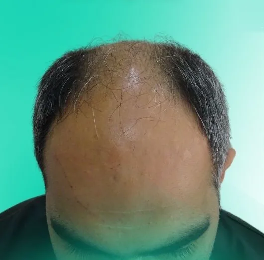 قبل زراعة الشعر، من الأعلى