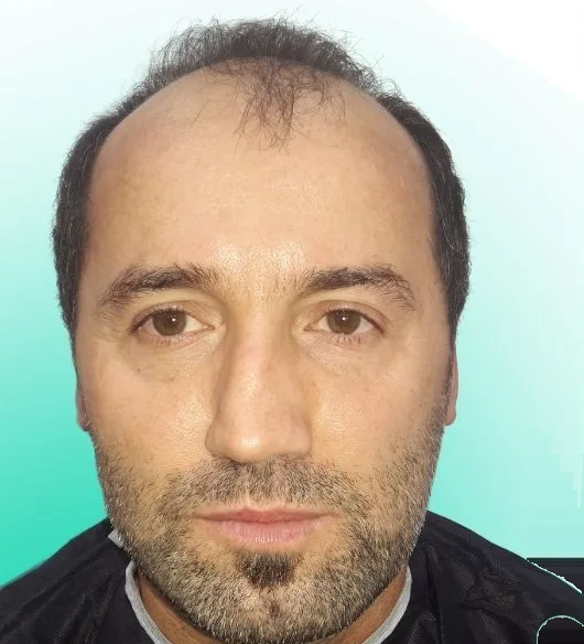 قبل زراعة الشعر، من الأمام