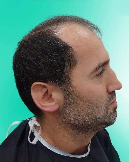 قبل زراعة الشعر، من الأعلى