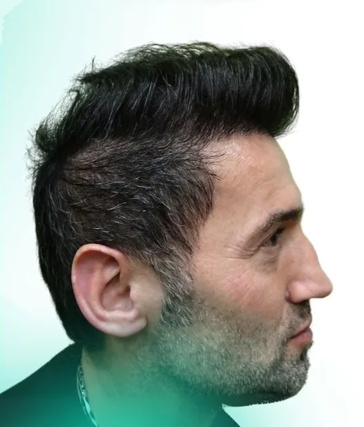 بعد زراعة الشعر، من الأعلى