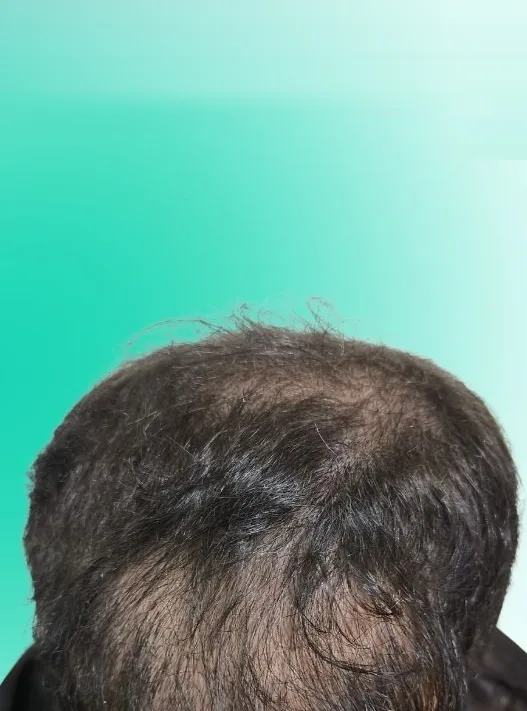 قبل زراعة الشعر، من الأمام