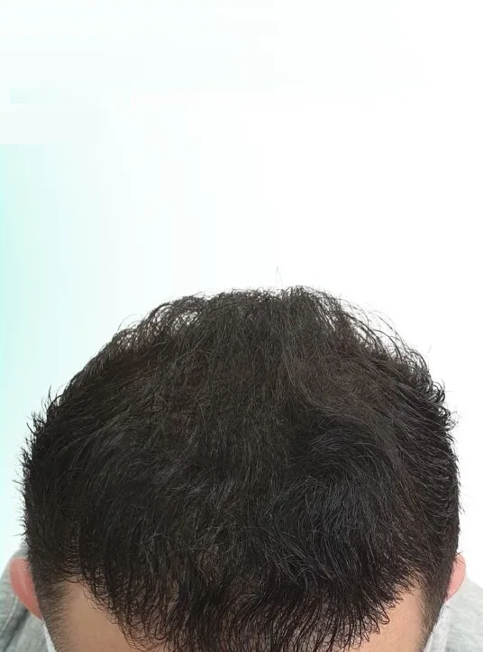 بعد زراعة الشعر، من الأمام