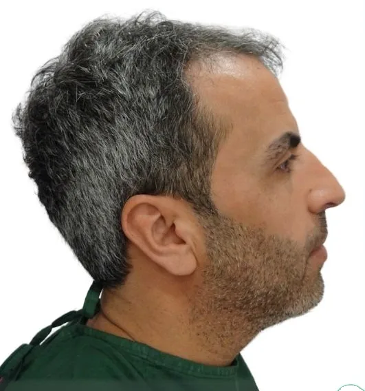 قبل زراعة الشعر، من الأمام