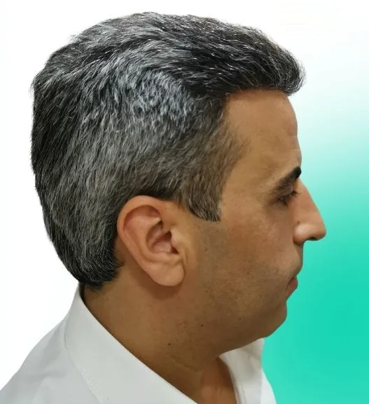 بعد زراعة الشعر، من الأمام