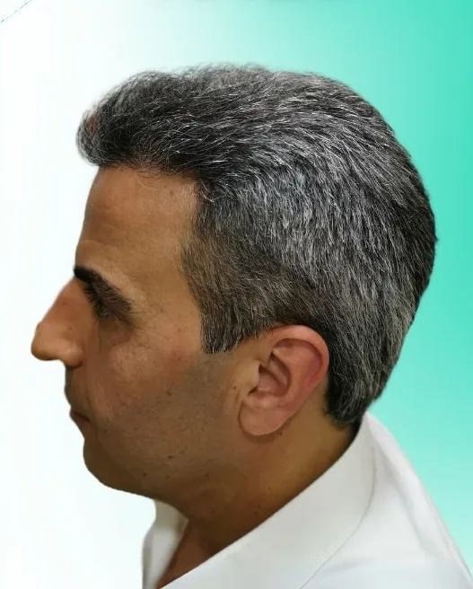 بعد زراعة الشعر، من الأعلى
