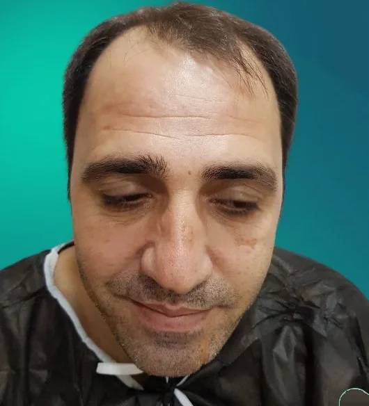 قبل زراعة الشعر، من الأمام