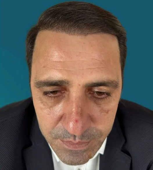 بعد زراعة الشعر، من الأمام