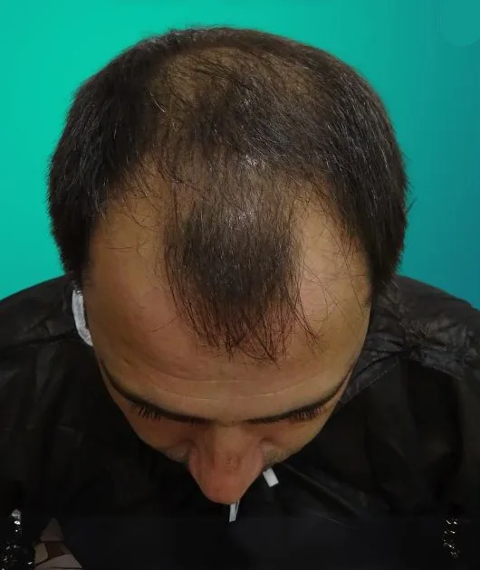 قبل زراعة الشعر، من الأعلى