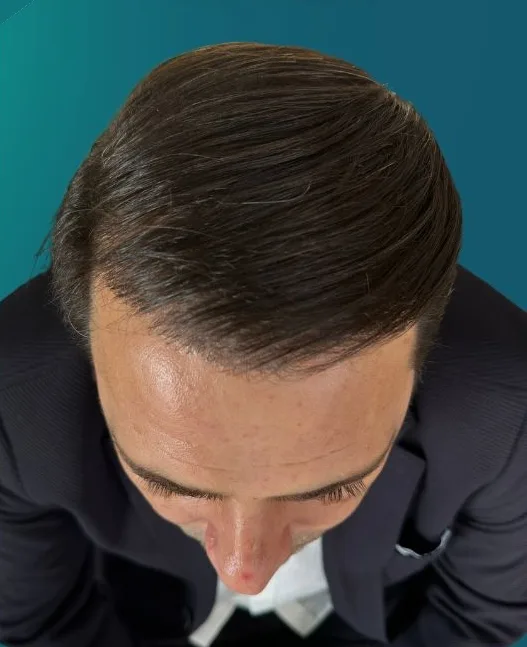بعد زراعة الشعر، من الأعلى