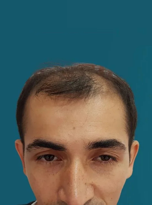 قبل زراعة الشعر، من الأمام