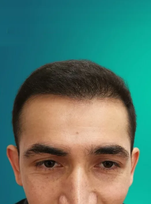 بعد زراعة الشعر، من الأمام