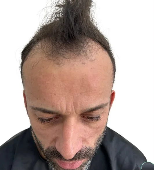 قبل زراعة الشعر، من الأمام