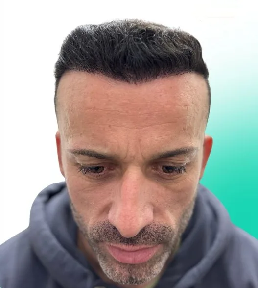 بعد زراعة الشعر، من الأمام