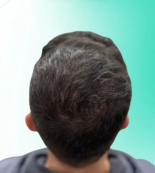 بعد زراعة الشعر، من الأعلى