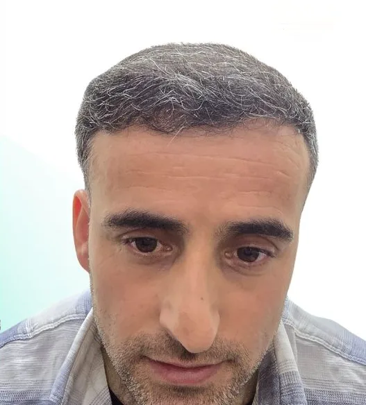 بعد زراعة الشعر، من الأمام