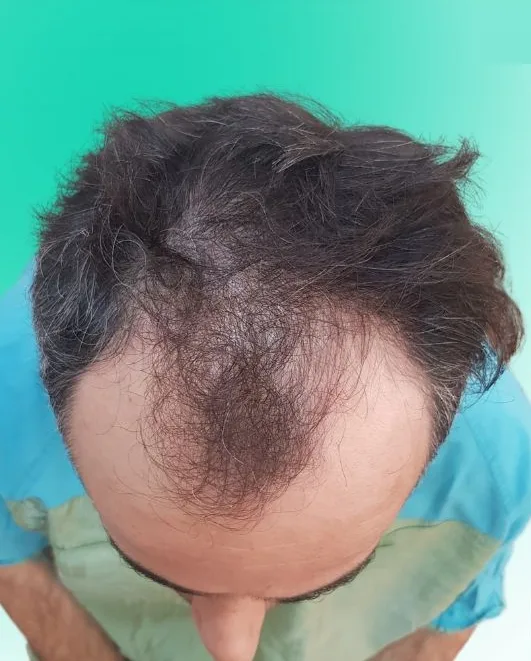 قبل زراعة الشعر، من الأعلى