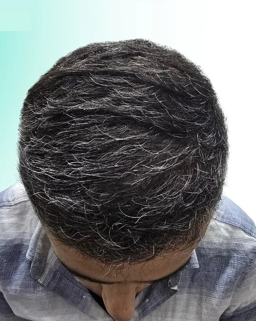 بعد زراعة الشعر، من الأعلى