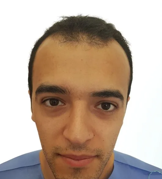 قبل زراعة الشعر، من الأمام