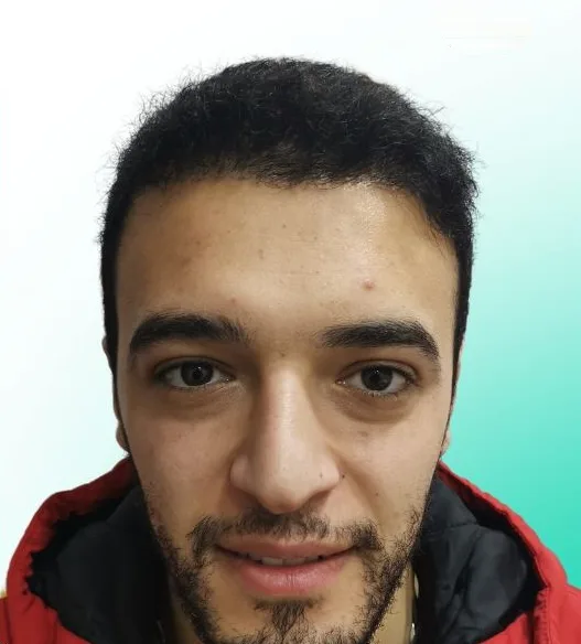 بعد زراعة الشعر، من الأمام