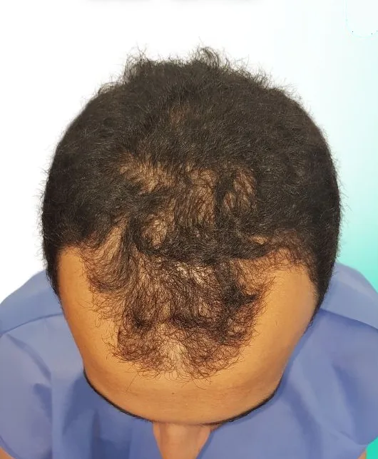 قبل زراعة الشعر، من الأعلى
