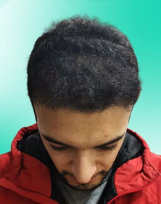 بعد زراعة الشعر، من الأعلى