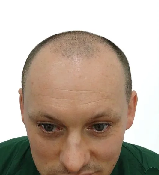قبل زراعة الشعر، من الأمام