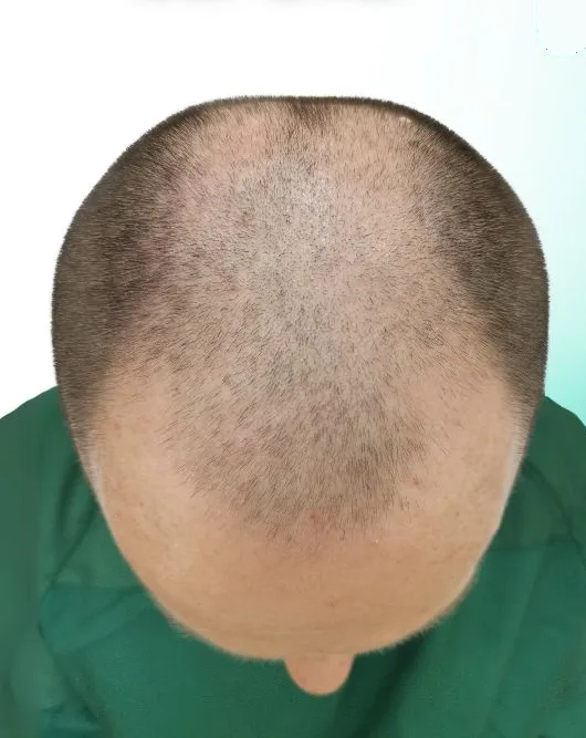 قبل زراعة الشعر، من الأعلى