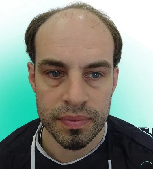قبل زراعة الشعر، من الأمام
