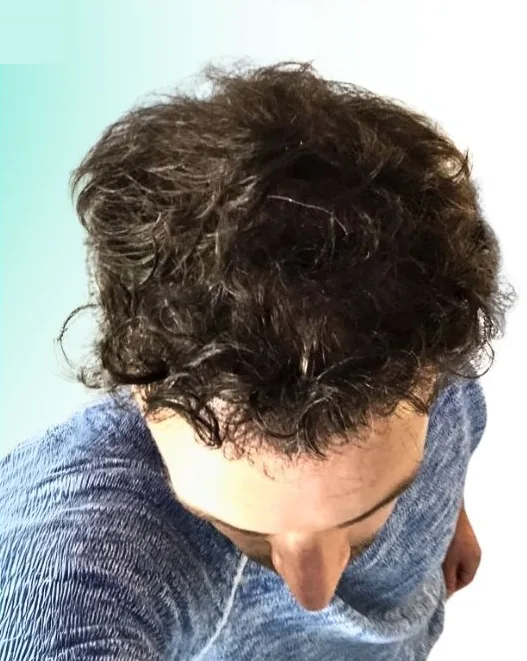 بعد زراعة الشعر، من الأعلى